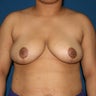 Breast Reduction