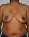 Breast Reduction