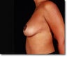 Breast Reduction
