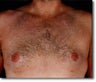 Male Breast Reduction 