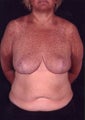 Minimal Scar Breast Reduction