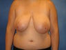 Breast Reduction