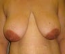 Breast Reduction
