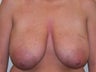 Breast Reduction