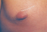 Male Breast reduction-Gynecomastia. Reduced size of nipples. 
