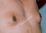 Male Breast reduction-Gynecomastia