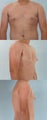 gynecomastia (mail breast reduction)