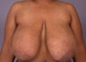 Breast Reduction