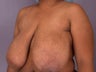 Breast Reduction