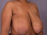 Breast Reduction