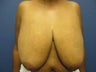 Breast Reduction
