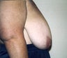 Breast Reduction