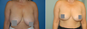Breast Reduction