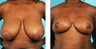 Breast Reduction