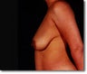 Breast Reduction