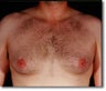 Male Breast Reduction 