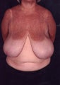 Minimal Scar Breast Reduction