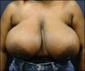 Breast Reduction