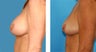 Breast Implant Removal with Internal Lift