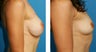 Breast Implant Removal