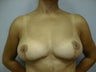 Breast Implant Removal and Lift