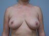 Breast Implant Removal
