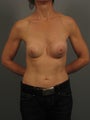 Implant Removal/Capsulectomy/Re-Aug