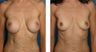 Breast Implant Removal