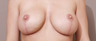 Breast Lift
