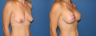 Breast Lift
