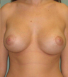 Breast Lift