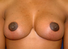 Breast Lift