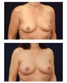 Breast Implants with lift