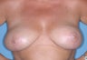 Breast Lift