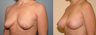 Breast Lift