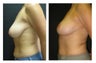 Breast Lift