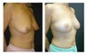 Breast Lift