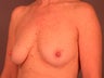 Breast lift with implants