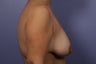 Breast lift with implants