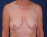 Breast Lift