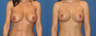 Breast Lift