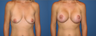 Breast Lift