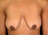 Breast Lift