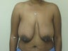 Breast Lift