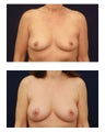 Breast Implants with lift