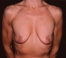 Breast Augmentation