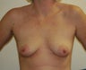 Breast Augmentation-Lift