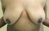Breast Lift