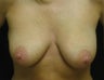 Breast Lift