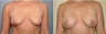 Breast Lift
